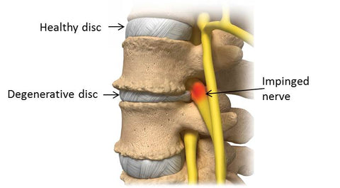 sciatica, nervo sciatico, allineamento della colonna vertebrale, postura, pureposture