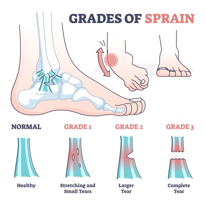 Un diagramma di un piede che mostra i diversi gradi di distorsione della caviglia, inclusi normale o sano, piccolo strappo di grado 1, strappo grande di grado 2 e strappo completo di grado 3.